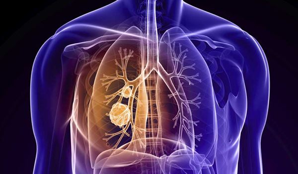 Chronic Obstructive Pulmonary Disease COPD